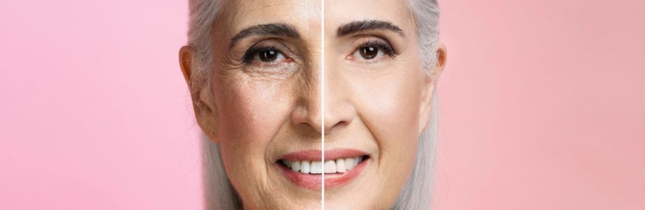 Hilos tensores: una solución efectiva para combatir la flacidez facial